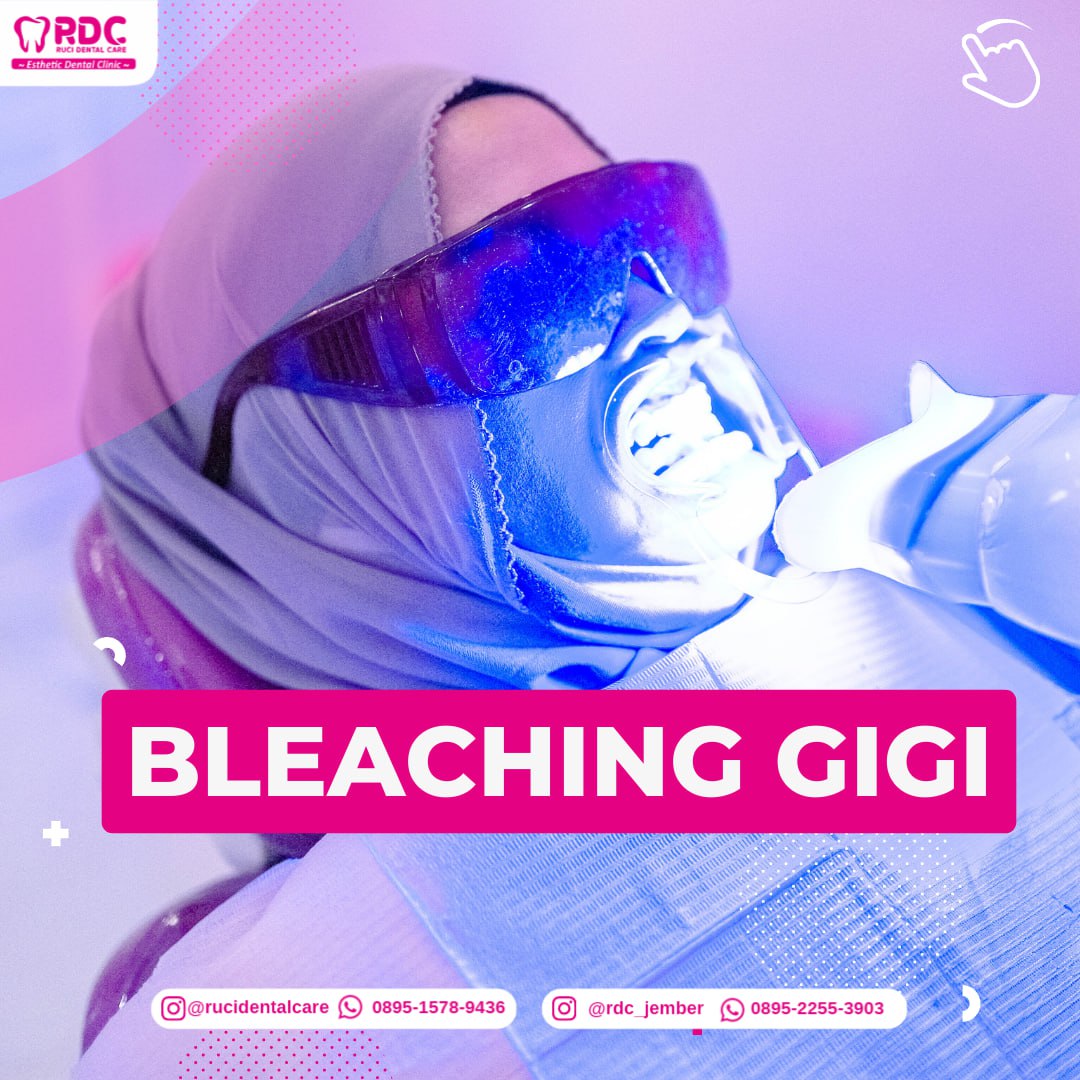 Bleaching Gigi