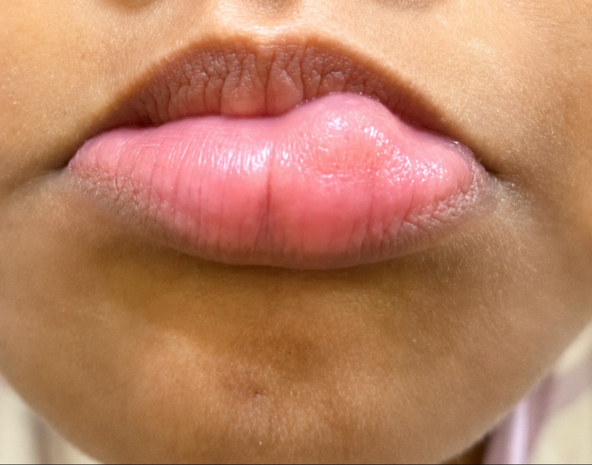Mucocele