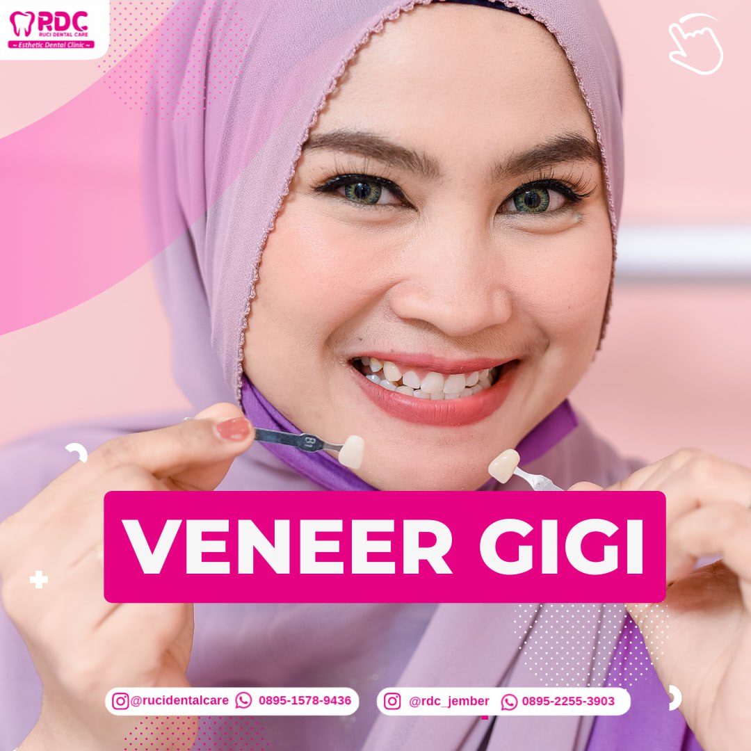 Veneer Gigi