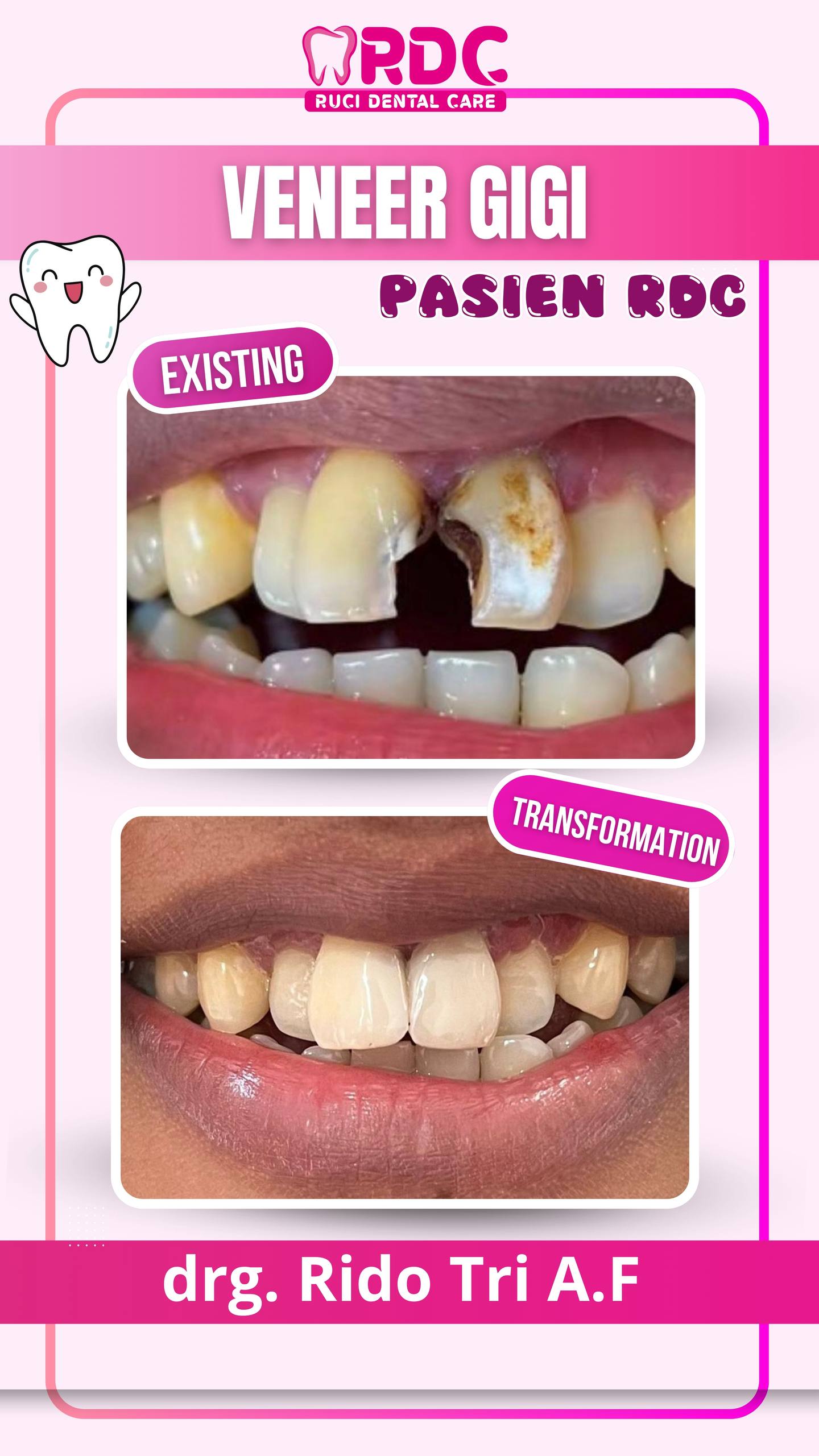 Veneer Gigi