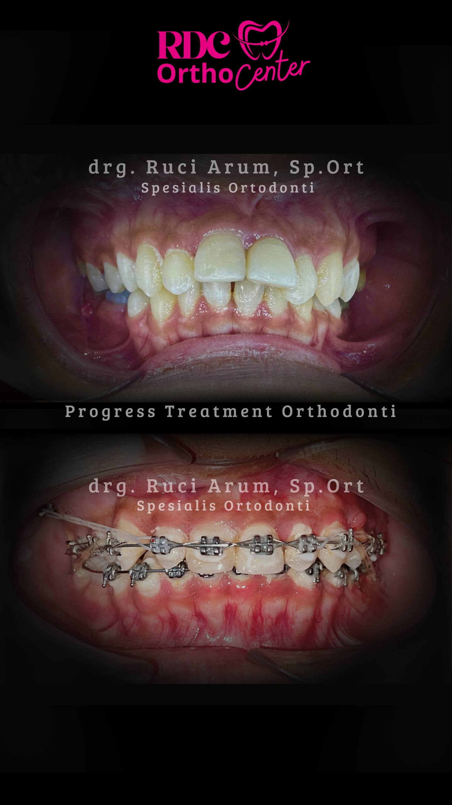 Behel Gigi / Ortodonti