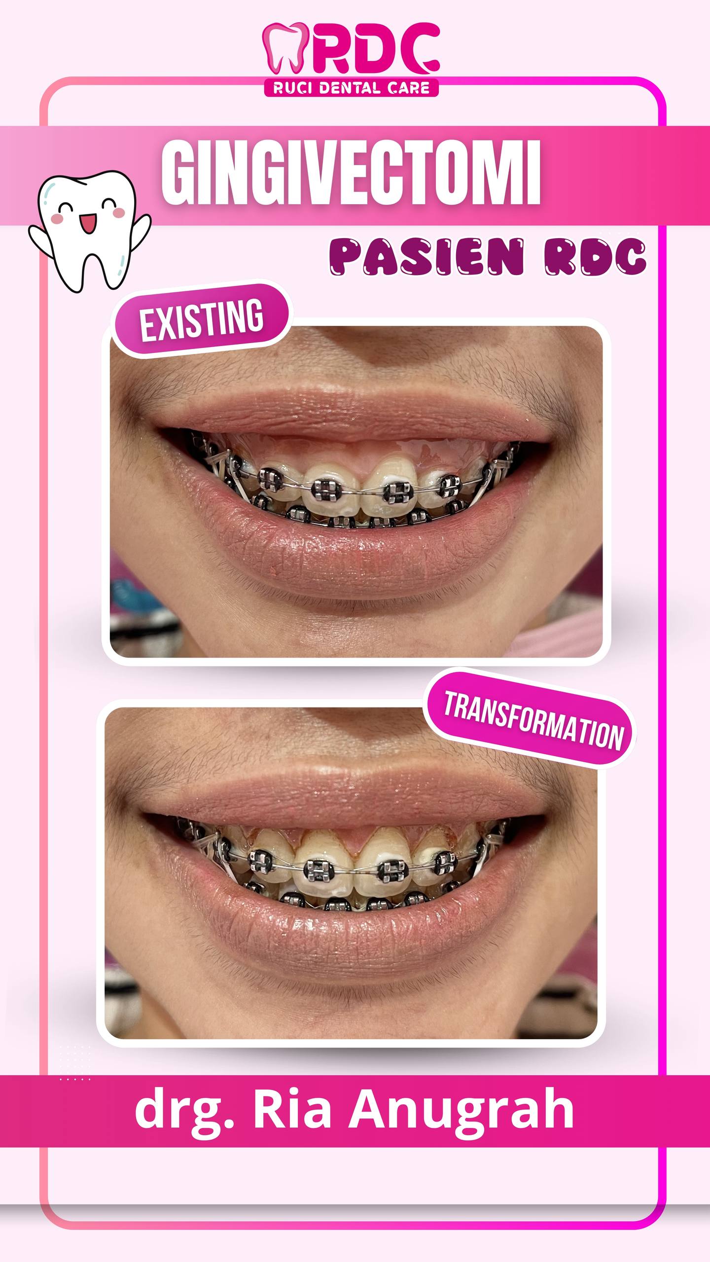 Gingivectomy / Potong Gusi
